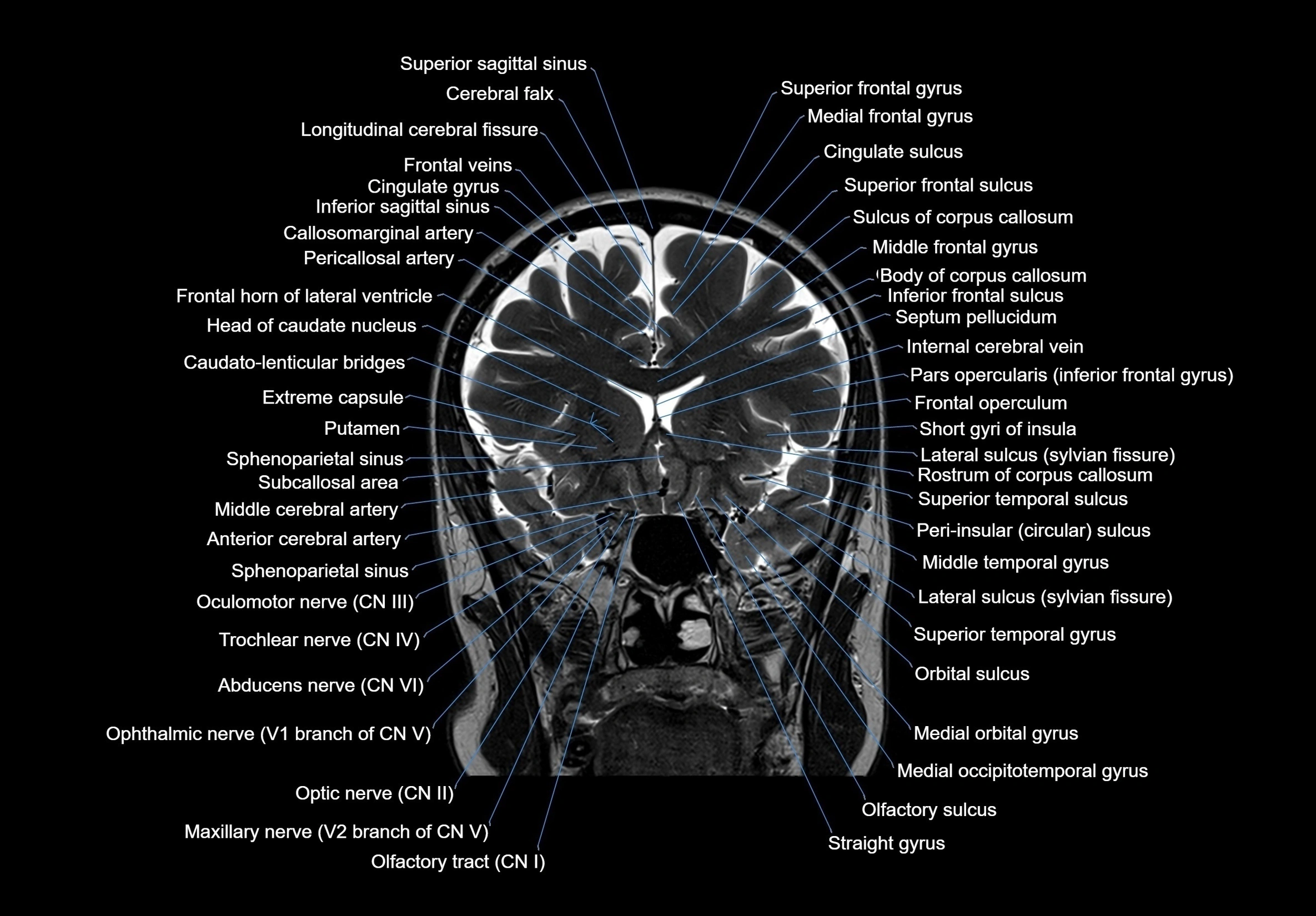 MRI Brain coronal cross sectional labelled anatomy 3T image  -img-00001-00027.webp